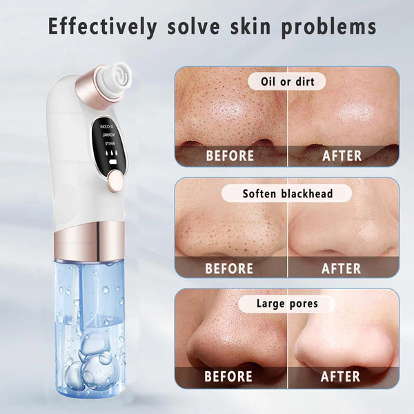 Pore Perfect Blackhead Vacuum